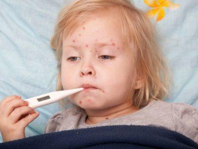 chicken pox vaccination glenrothes fife